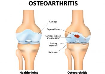 Osteoarthritis