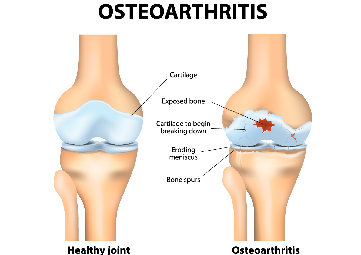 Read more about the article Tips for Managing Lower Limb Osteoarthritis With Exercise