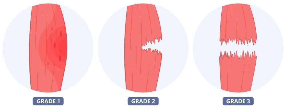 An examination will help figure out what grade of strain you have.