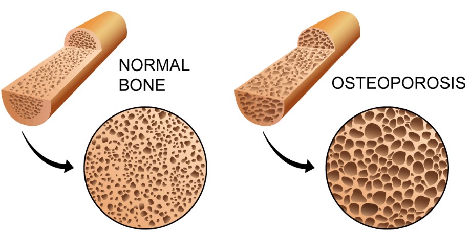 Normal bone and bone with osteoporosis illustration.