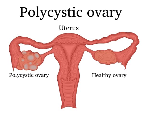 Polycystic ovary syndrome (PCOS) can also lead to severe mental health issues including anxiety, depression, and eating disorders.